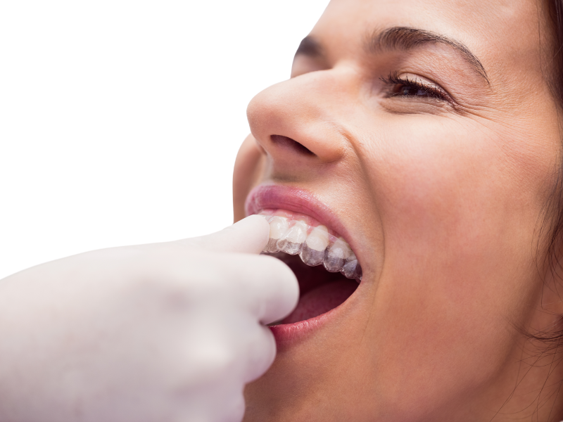 Paciente colocándose un alineador invisible Invisalign en clínica dental en Valladolid – Serna Dental