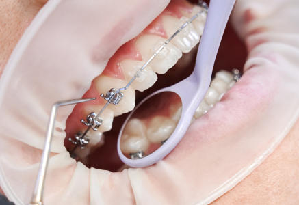 rackets estéticos colocados en dientes en clínica dental en Valladolid – Serna Dental