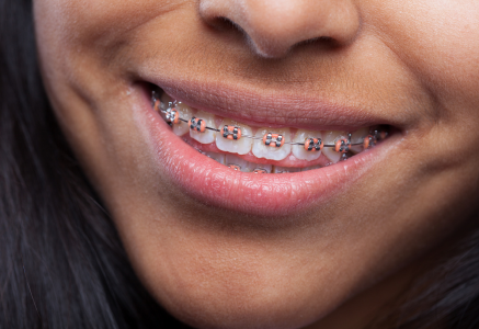 Brackets Tradicionales o convencionales