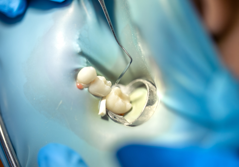 anestesia endodoncia