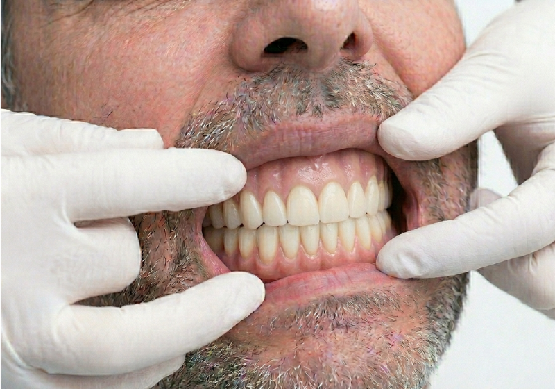 Dentadura postiza completa anclada sobre implantes de titanio en modelo dental de laboratorio Valladolid