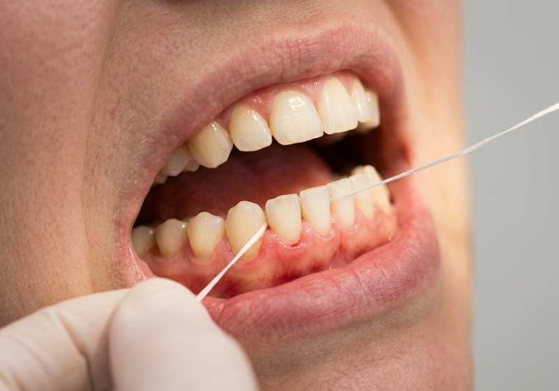 Uso de hilo dental para cuidar las encías y prevenir la periodontitis en Valladolid